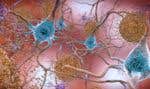 Illustration représentant des cellules dans un cerveau atteint de l’alzheimer, avec des niveaux anormaux de la protéine bêta-amyloïde qui s’agglutinent pour former des plaques, en marron, qui s’accumulent entre les neurones et perturbent le fonctionnement des cellules.